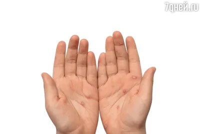 Пузырьки на пальцах рук: фото в формате JPG