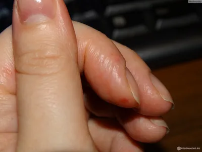 Пузырьки на пальцах рук: фото в формате PNG с прозрачным фоном