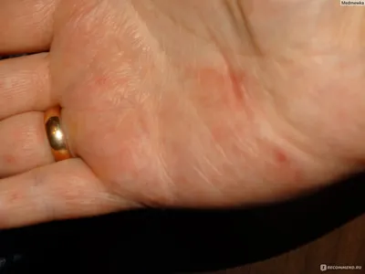 Пузырьки на пальцах рук: изображение в высоком разрешении