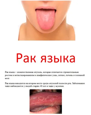 Онколог рассказал россиянам о причинах возникновения рака языка: Общество:  Россия: Lenta.ru