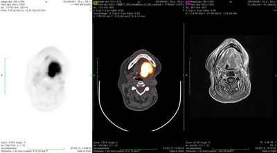 Борис: рак языка | NEOPLASTY