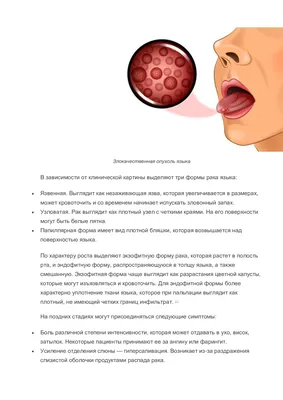 Рак языка симптомы