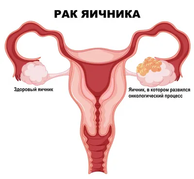 Вектор Знак Стоп Рак — стоковые фотографии и другие картинки Обследование  на рак - Обследование на рак, Stop - английское слово, Жест стоп - iStock