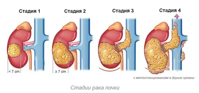 Как диагностируют рак поджелудочной?