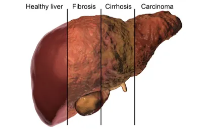 Рак Легких Болезни Легких 3d Иллюстрация — стоковые фотографии и другие  картинки Рак лёгких - Рак лёгких, Лёгкое, Медицинский осмотр - iStock