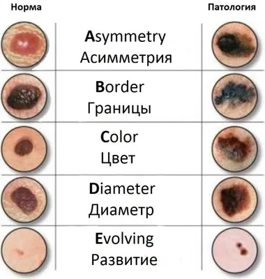 Рак кожи — Томский областной кожно-венерологический диспансер