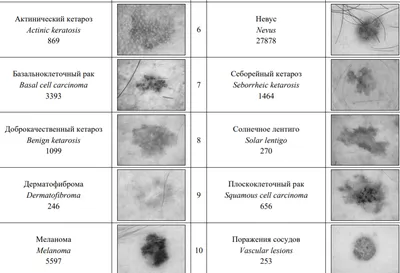 Рак кожи: фото, симптомы, плоскоклеточный, базальноклеточный, меланома