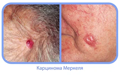 Хлои Кардашьян показала лицо после меланомы - фото | РБК Украина