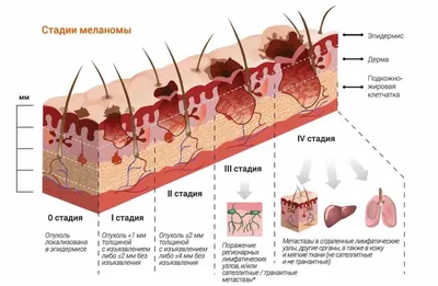 Рак кожи - симптомы и признаки | Центр лечения онкологии СМ-Клиники