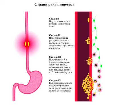 Рак пищевода: симптомы, причины, классификация, прогноз, выживаемость