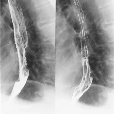 Рак пищевода – Дисфагия
