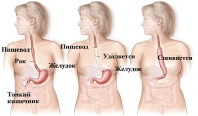 Рак пищевода: симптомы, причины, классификация, диагностика и лечение,  прогноз