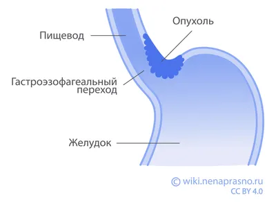 Лечение рака пищевода - Онкология в Белоруссии: клиники, врачи, методы