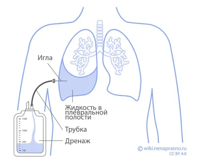 Doctor BOSTI - ⠀⠀На долю рака пищевода приходится каждый восьмой случай  смерти от рака в мире. ⤵️Вот пять ранних симптомов, которые нельзя  пропустить. ⠀ ⠀⠀Рак пищевода – самый распространенный вид злокачественных  опухолей