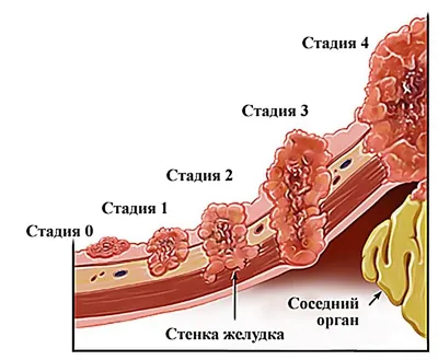 Рак пищевода: симптомы, признаки, диагностика и лечение