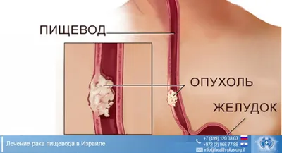 Рак пищевода