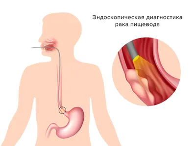 Диагностика: рак пищевода, желудка, кишечника в СПб - Euromed