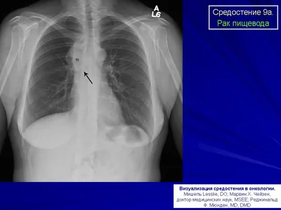 Medtronic Russia - Апрель – месяц осведомленности о раке пищевода. В России  ежегодно рак пищевода регистрируется у более 8000 человек. Это одно из  самых агрессивных злокачественных заболеваний, которое занимает 8-е место по