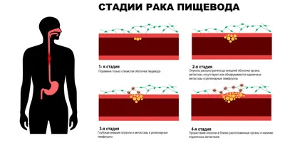 Рак пищевода: первые симптомы, признаки, диагностика и лечение