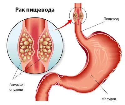 Рак пищевода - причины появления, симптомы заболевания, диагностика и  способы лечения