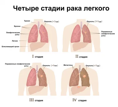 Рак легкого - причины появления, симптомы заболевания, диагностика и  способы лечения