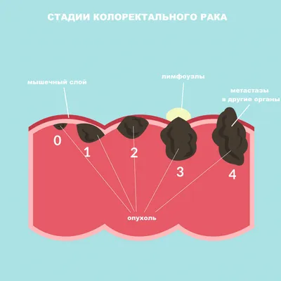 МРТ при раке молочной железы - протокол, признаки на МРТ снимках