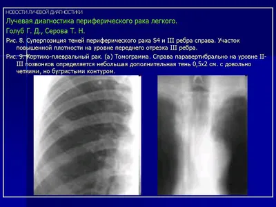 Лучевая картина центрального рака легкого - 97 фото