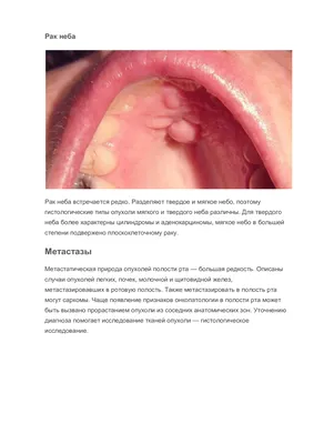 Злокачественные опухоли полости рта