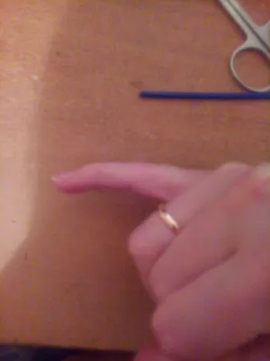 Фото растяжения связок пальца руки с дополнительной подсветкой
