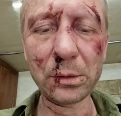 Популярный актер из Саратова показал сильно разбитое лицо — Регион 64