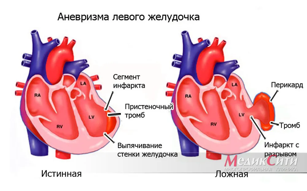 Кардиоконтроль. Постинфарктная аневризма левого желудочка на ЭКГ. Аневризма левого желудочка клинические рекомендации. Постинфарктная аневризма левого желудочка симптомы. Хроническая аневризма лж.