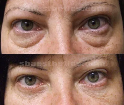 Изображения восстановления глаз после блефаропластики