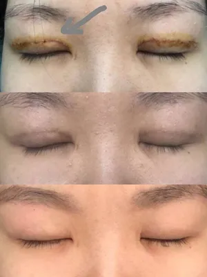 Реабилитация после блефаропластики: фотоотчет о восстановлении глаз по дням