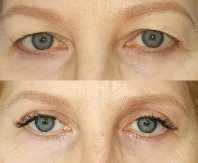 Фотографии до и после операции на верхних веках: реабилитация глаз