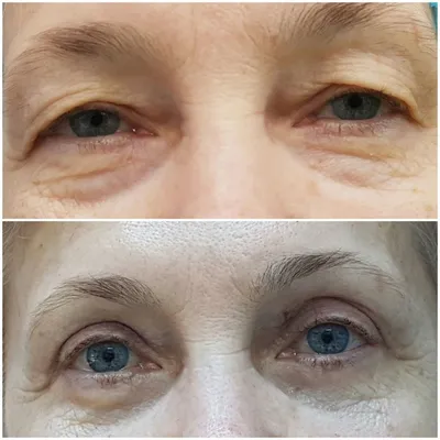 Фотоотчет о процессе восстановления глаз после блефаропластики