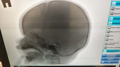 Рентген черепа ребенка: изображение в высоком качестве
