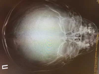 Фотография рентгена черепа ребенка для диагностики заболеваний