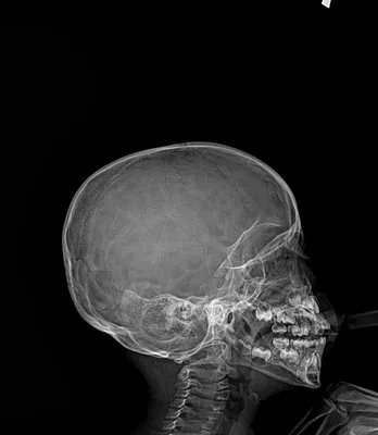 Рентген черепа ребенка: фото с возможностью увеличения