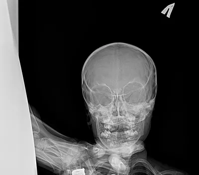 Фото рентгена черепа ребенка для медицинских учреждений