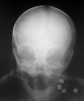 Изображение рентгена черепа ребенка с комментариями врача