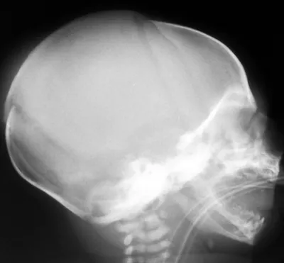 Рентген черепа ребенка в формате PNG