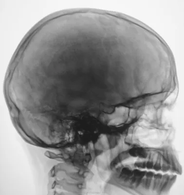 Рентген черепа ребенка: фото для исследования структуры кости