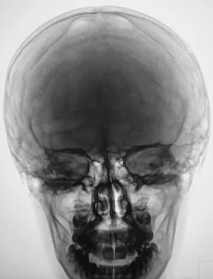Изображение рентгена черепа ребенка: точное и надежное фото