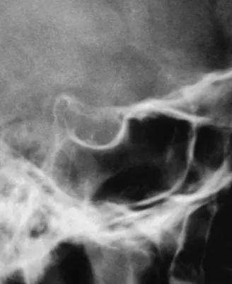 Изображение рентгена черепа ребенка в PNG