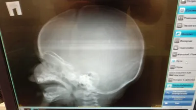 Рентген черепа ребенка: красивое и точное изображение