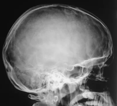 Картинка рентгена черепа ребенка для профессионалов