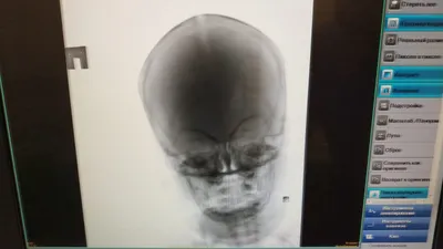 Фотография рентгена черепа ребенка в WebP формате