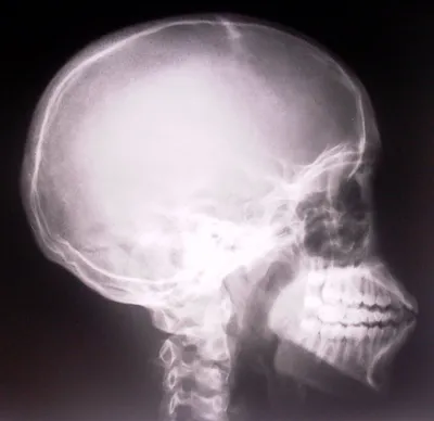 Фото рентгена черепа на белом фоне
