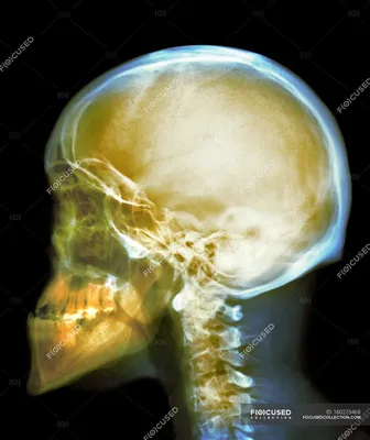 Фото черепа в рентгеновском излучении