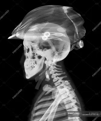 Рентген черепа для ортопедических протезов